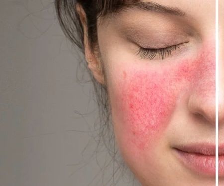How To Avoid Rosacea: What You Need To Know