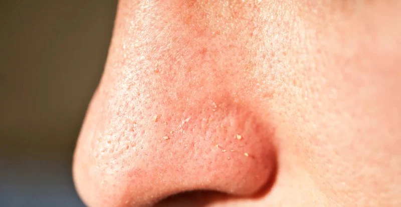 How to Heal Your Whiteheads with These 15 Tips: Clear Your Skin Fast