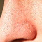 How to Heal Your Whiteheads with These 15 Tips: Clear Your Skin Fast