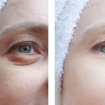 How To Get Rid Of Puffy Eyes Effectively