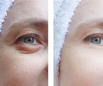 How To Get Rid Of Puffy Eyes Effectively