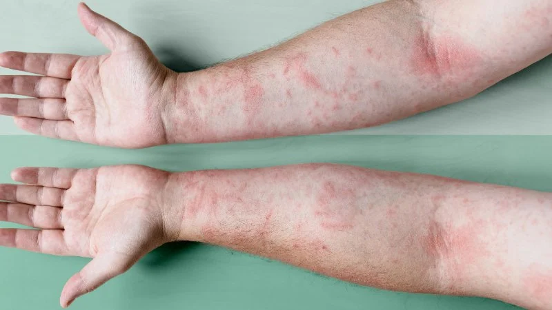 How to Heal Eczema: What You Need to Know