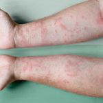 How to Heal Eczema: What You Need to Know