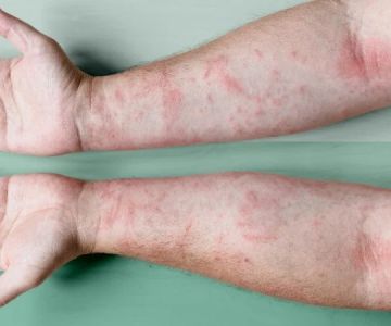 How to Heal Eczema: What You Need to Know