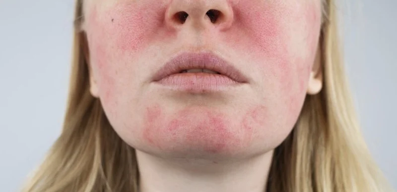 How To Detoxify Your Rosacea With These 15 Tips