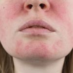 How To Detoxify Your Rosacea With These 15 Tips