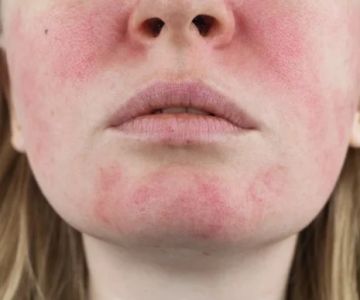 How To Detoxify Your Rosacea With These 15 Tips