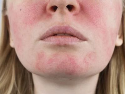 How To Detoxify Your Rosacea With These 15 Tips
