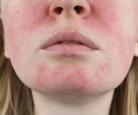 How To Detoxify Your Rosacea With These 15 Tips