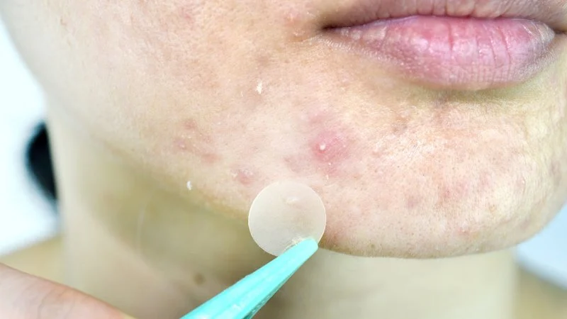 How to Soothe Whiteheads Using Natural Remedies for Clearer Skin