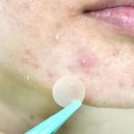 How to Soothe Whiteheads Using Natural Remedies for Clearer Skin