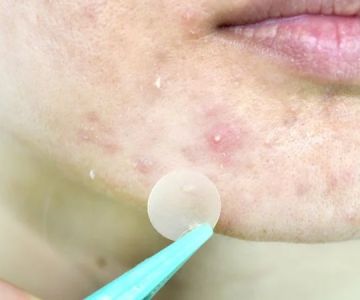 How to Soothe Whiteheads Using Natural Remedies for Clearer Skin