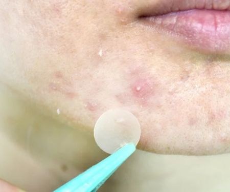 How to Soothe Whiteheads Using Natural Remedies for Clearer Skin