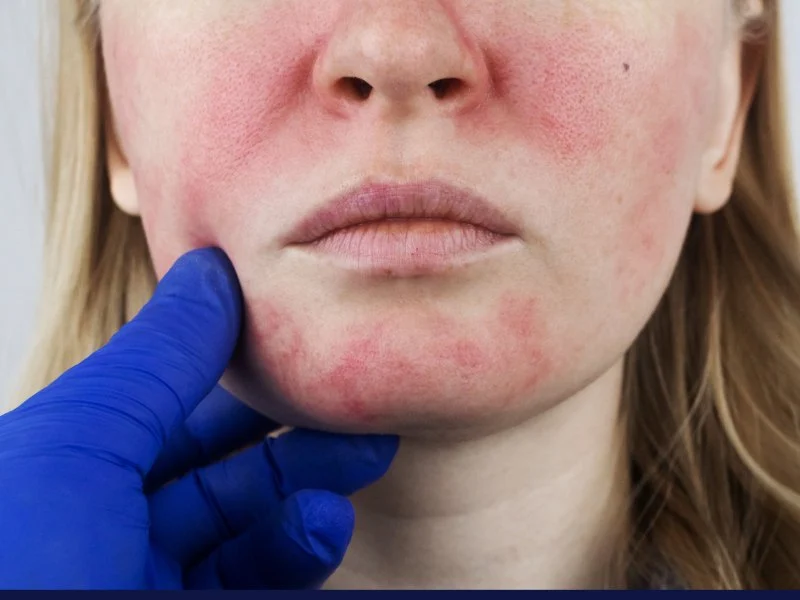 Benefits of Using Rosacea and How to Manage It