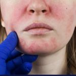 Benefits of Using Rosacea and How to Manage It
