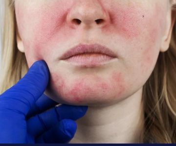 Benefits of Using Rosacea and How to Manage It