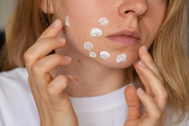 How To Choose The Right Hyperpigmentation Treatment: What You Need To Know