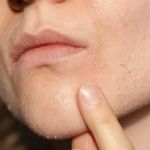 How to Treat and Prevent Dryness Around Your Mouth and Chin