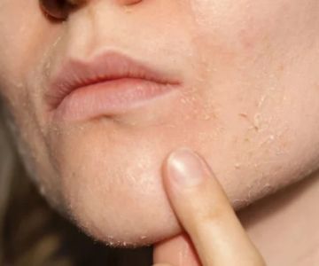How to Treat and Prevent Dryness Around Your Mouth and Chin