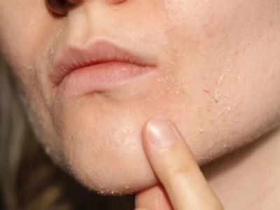 How to Treat and Prevent Dryness Around Your Mouth and Chin