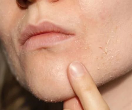 How to Treat and Prevent Dryness Around Your Mouth and Chin