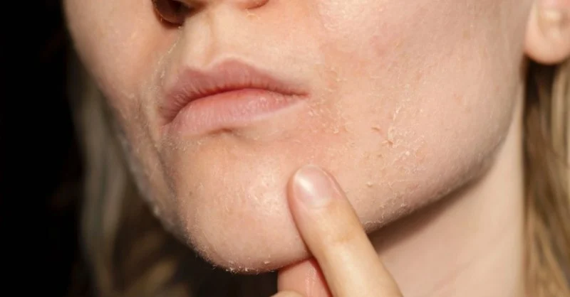 The Best Natural Remedies for Skin Dryness and Irritation