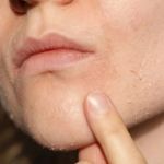 The Best Natural Remedies for Skin Dryness and Irritation