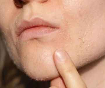 The Best Natural Remedies for Skin Dryness and Irritation