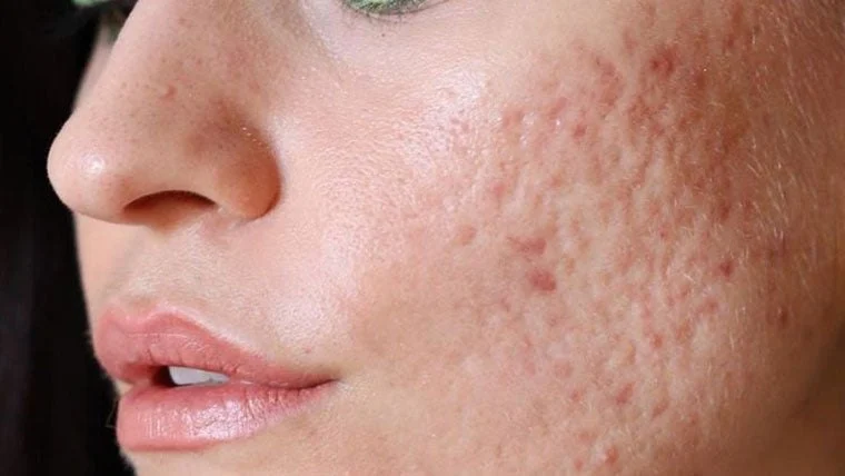 How to Treat and Prevent Acne Scars with Consistent Skin Care