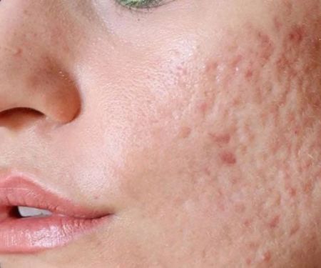 How to Treat and Prevent Acne Scars with Consistent Skin Care