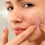 How to Prevent Redness Effectively