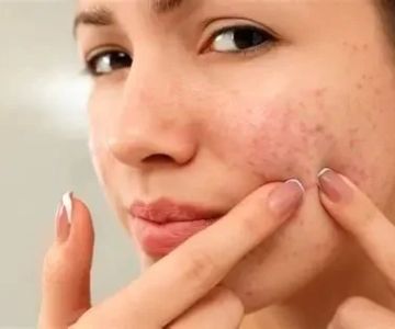 How to Prevent Redness Effectively