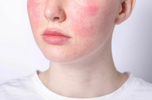 How to Get Rid of Redness and Inflammation in Skin Naturally
