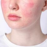 How to Get Rid of Redness and Inflammation in Skin Naturally
