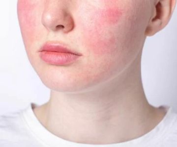 How to Get Rid of Redness and Inflammation in Skin Naturally