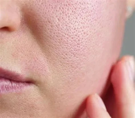 Best Ingredients For Large Pores And How To Manage It