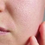 Best Ingredients For Large Pores And How To Manage It