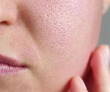 Best Ingredients For Large Pores And How To Manage It