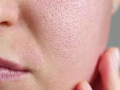 Best Ingredients For Large Pores And How To Manage It
