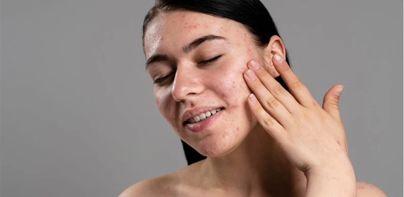 What You Need to Know About Using Toner for Acne-Prone Skin