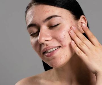 What You Need to Know About Using Toner for Acne-Prone Skin