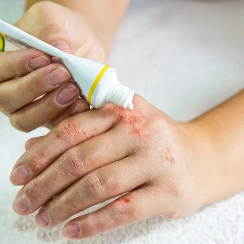 How To Get Rid Of Eczema Effectively