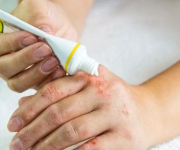 How To Get Rid Of Eczema Effectively