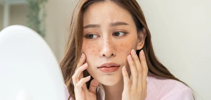 Everything You Need To Know About Uneven Skin Tone And How To Manage It