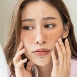 Everything You Need To Know About Uneven Skin Tone And How To Manage It