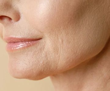 How to Treat and Prevent Fine Lines Around Your Eyes and Mouth