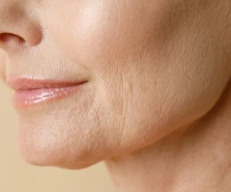 How to Treat and Prevent Fine Lines Around Your Eyes and Mouth