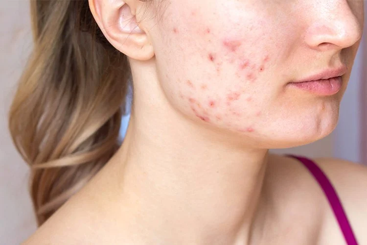 How to Treat Acne Breakouts with Simple and Natural Skincare Solutions