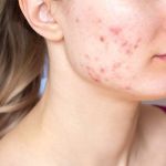 How to Treat Acne Breakouts with Simple and Natural Skincare Solutions