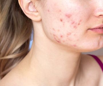 How to Treat Acne Breakouts with Simple and Natural Skincare Solutions